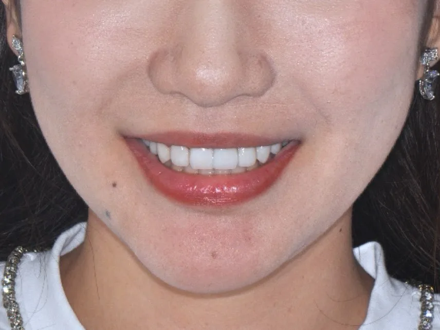 Porcelain Veneers & Smile Design